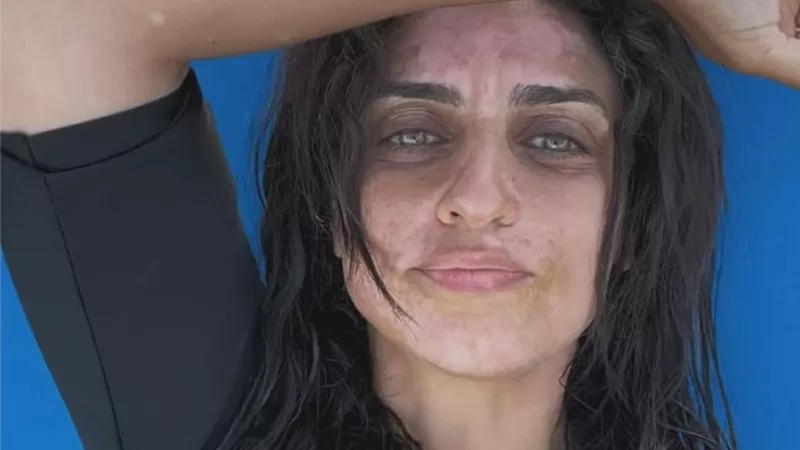شقيقة أمير كرارة.. نجوم ومشاهير كان البهاق نقطة تحول في حياتهم