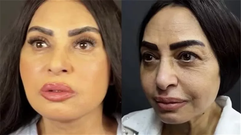 سلوى خطاب تكشف تفاصيل خضوعها لعمليات تجميل